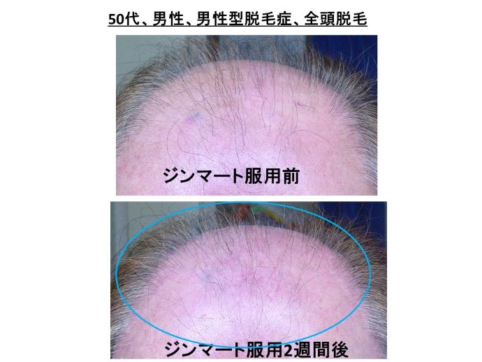 円形脱毛症　病院